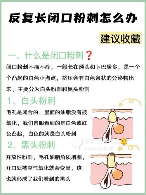 如何去除脸上粉刺